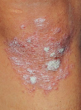 Psoriasis hné