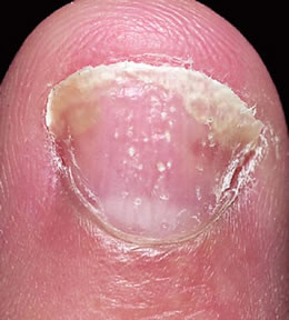 Naglpsoriasis