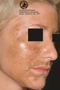 Melasma hjá ungri konu